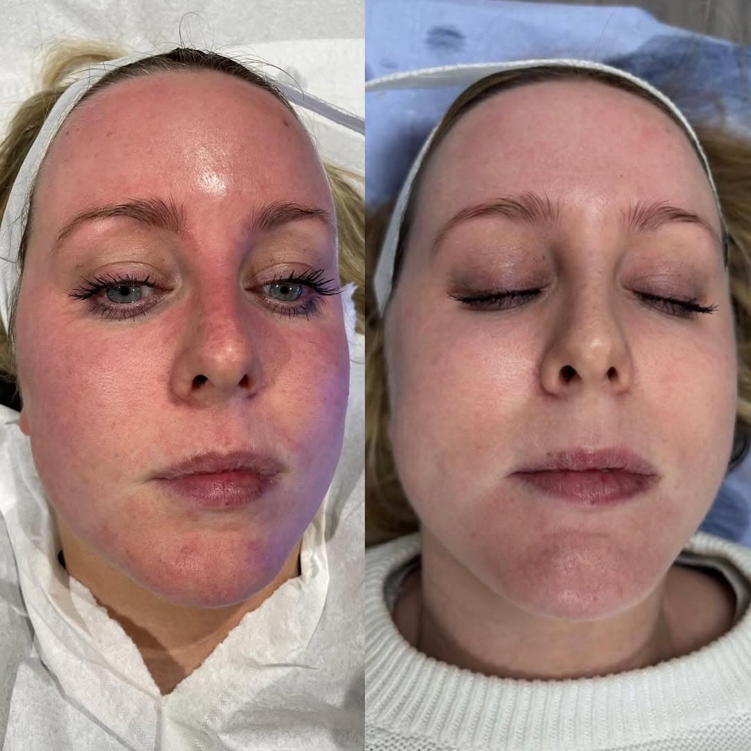 Skin Resurfacing & Redness
