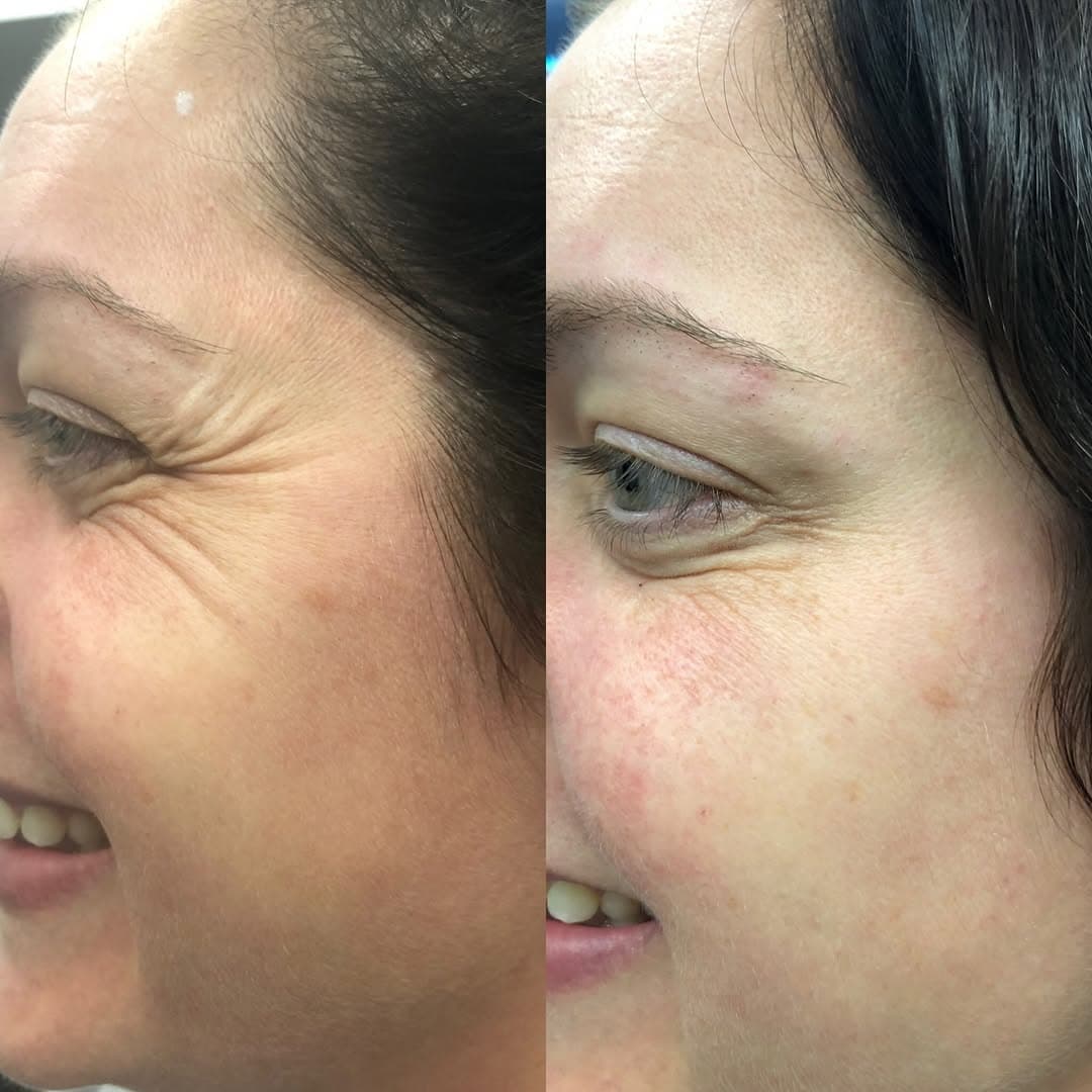 Anti-Wrinkle — Crow's Feet