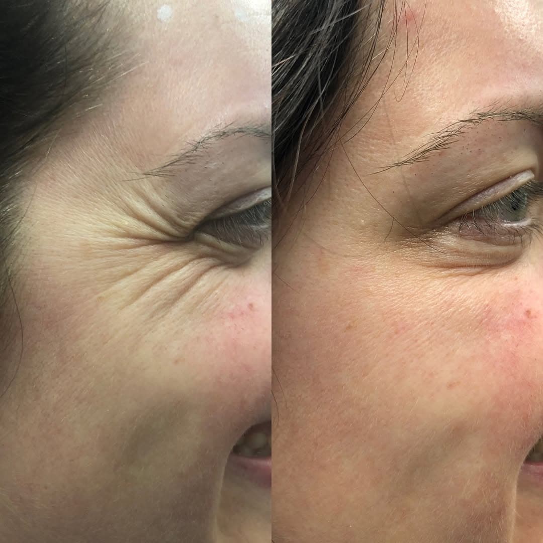 Anti-Wrinkle Treatment