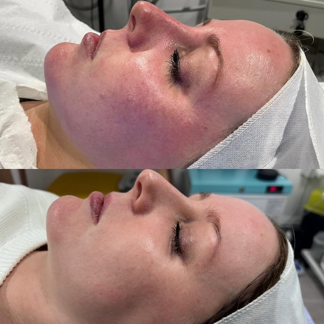 Redness & Rosacea